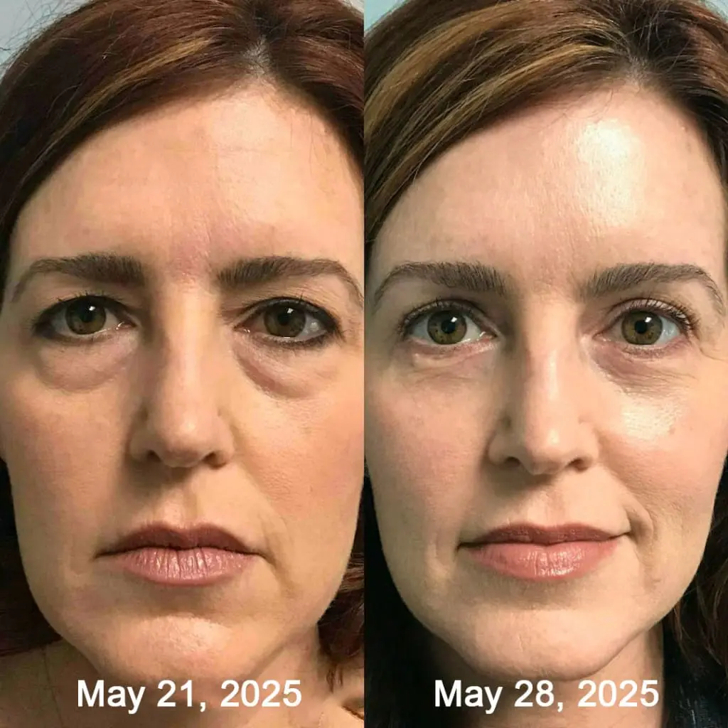 Botox & Retinol Shot - Eraser for deep wrinkles - Image 19