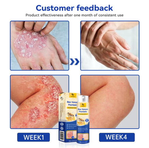 PsoriaHeal Bee Venom Psoriasis Treatment Spray plus - Image 5
