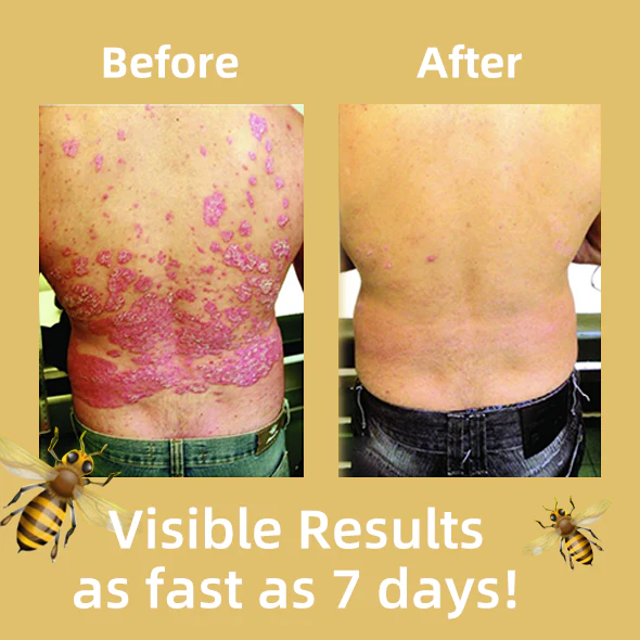 Cvreoz Bee Venom Psoriasis Treatment Cream - Image 2