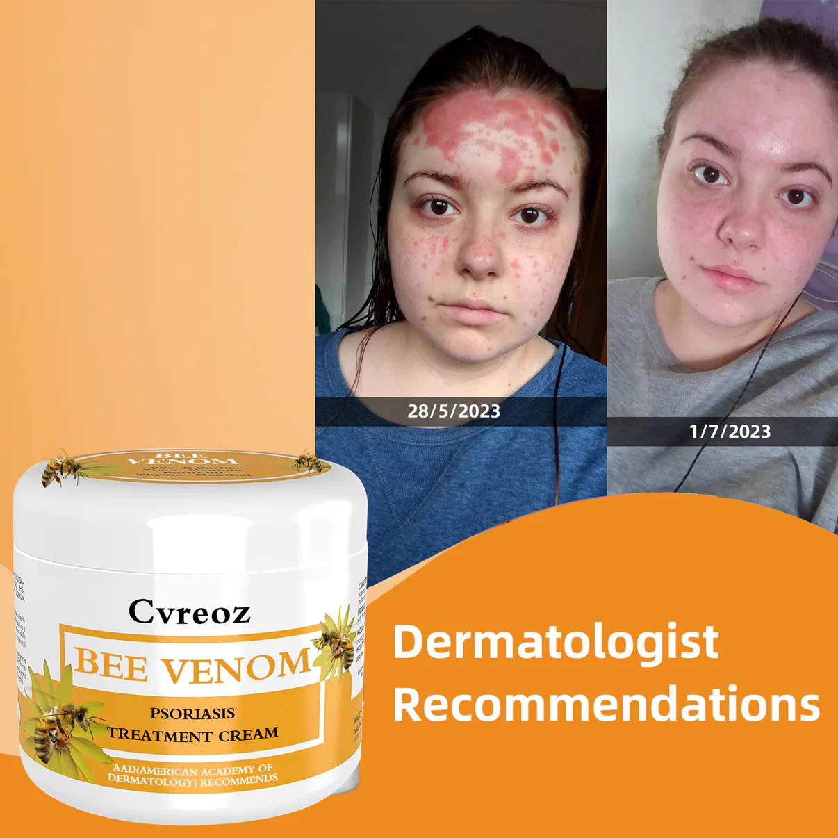 Cvreoz Bee Venom Psoriasis Treatment Cream - Image 3