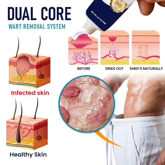 Genital Warts Remover Cream 👨Designed for Men - Image 4