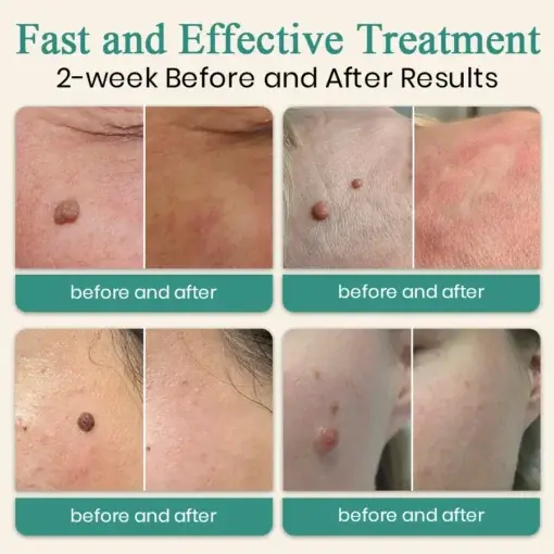 LumeSkin Mole and Wart Instant Removal Laser Pen - Image 2
