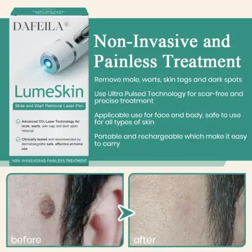 LumeSkin Mole and Wart Instant Removal Laser Pen - Image 4