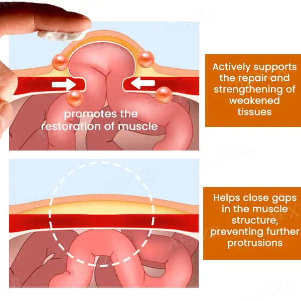 Hernia Treatment Cream - Image 4