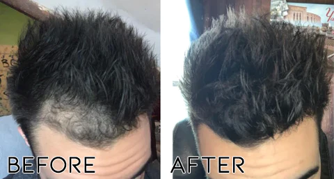 Minoxidil Hair Regrowth Treatment - Image 4