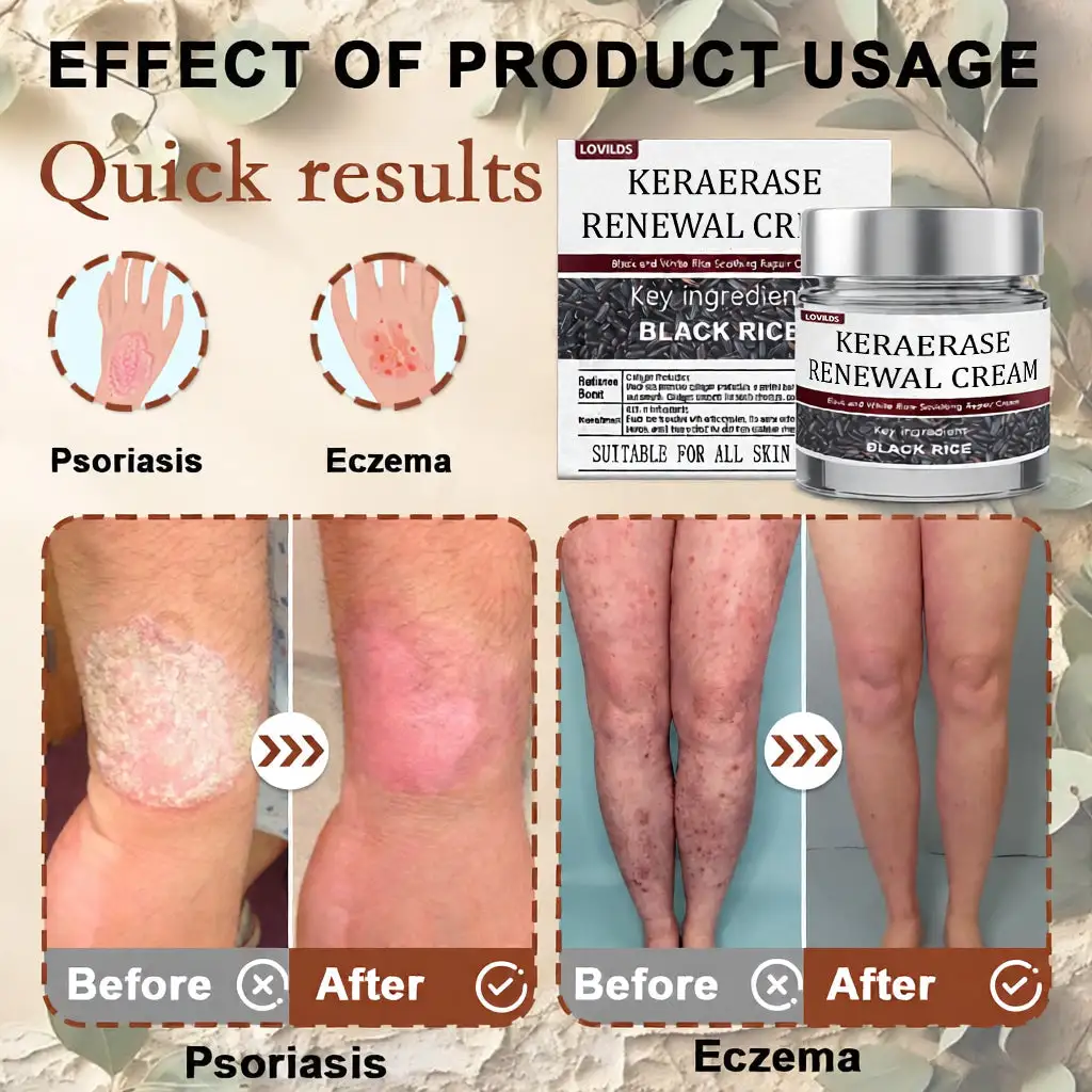 Flash Sale: KeraErase Dual-Action Renewal Cream - Image 2