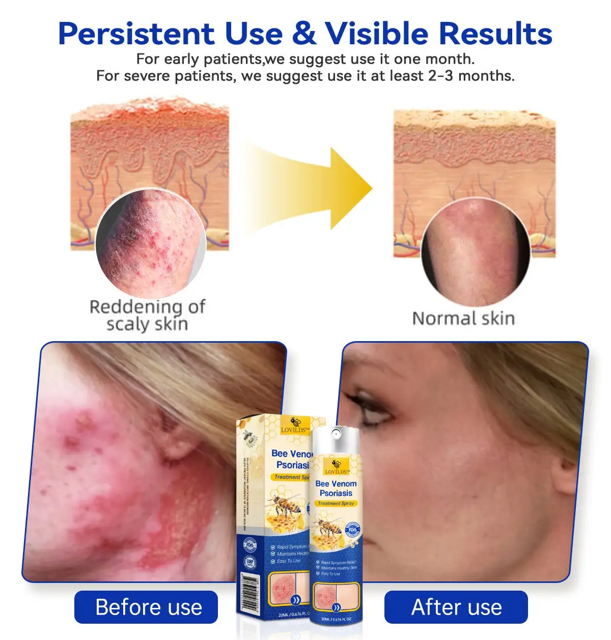 PsoriaHeal psoriasis Spray - Image 3