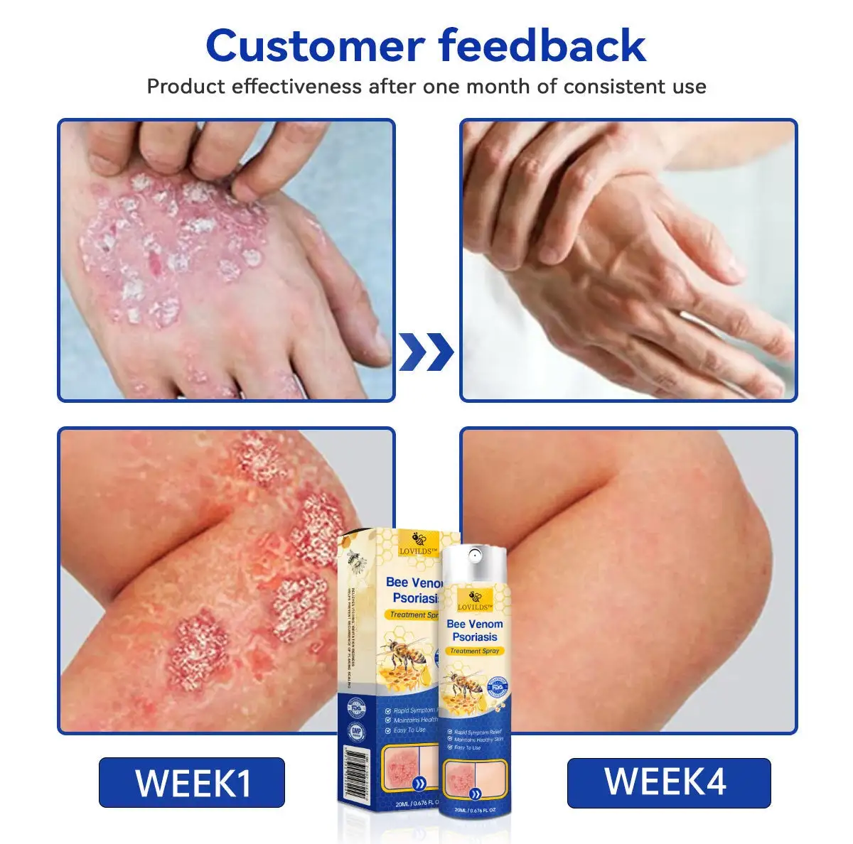 PsoriaHeal psoriasis Spray - Image 6