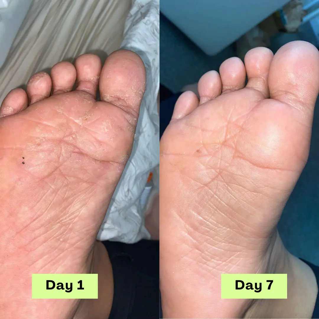 AntiFungal Relief Soap Bar - Image 6