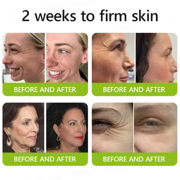 Botox & Retinol Shot - Image 14