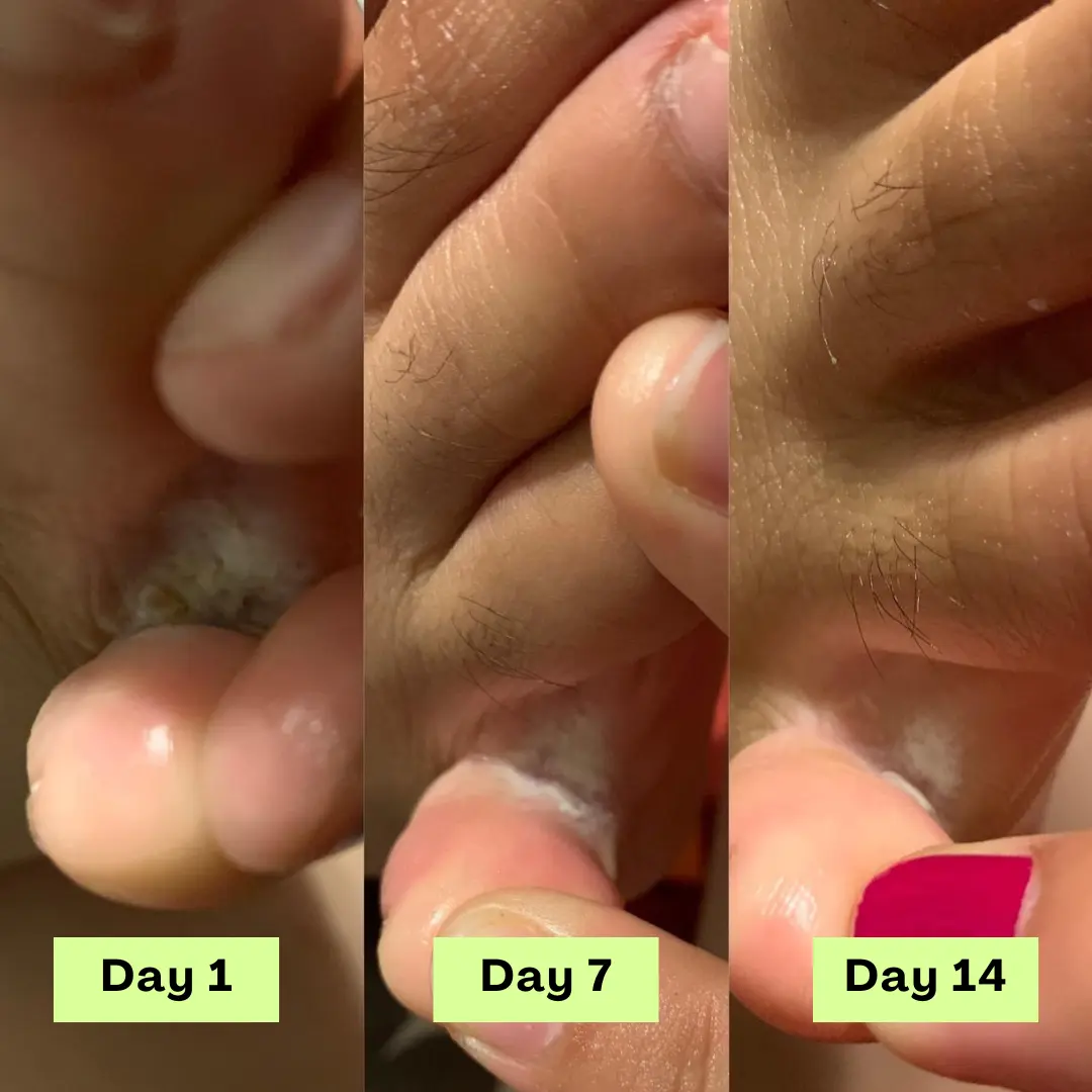 AntiFungal Relief Soap Bar - Image 7