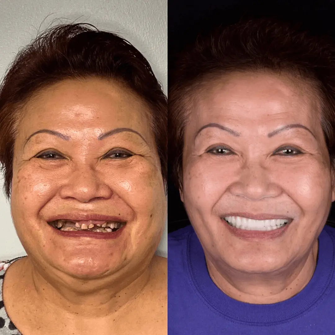 BioFusion Dentures - Image 5