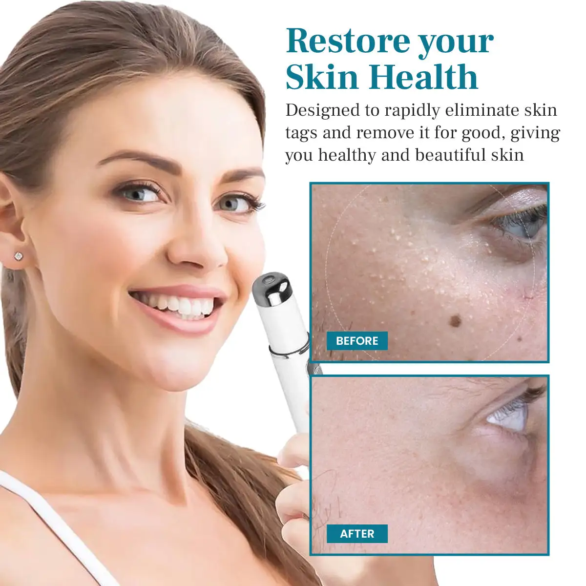 Non-invasive Mole and Wart Removal Laser Pen - Image 6