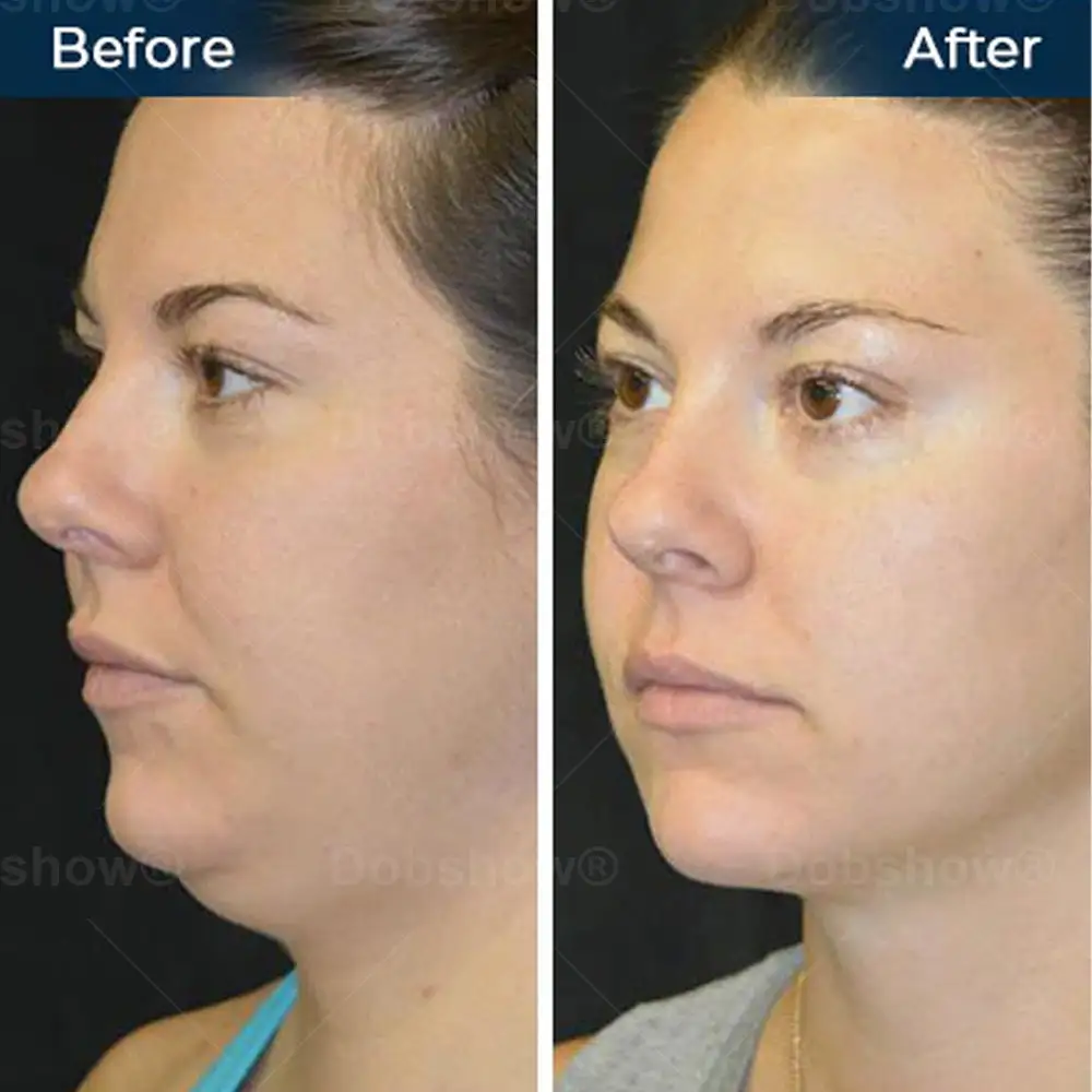 Sleeping V-Face Beauty Device - Image 7