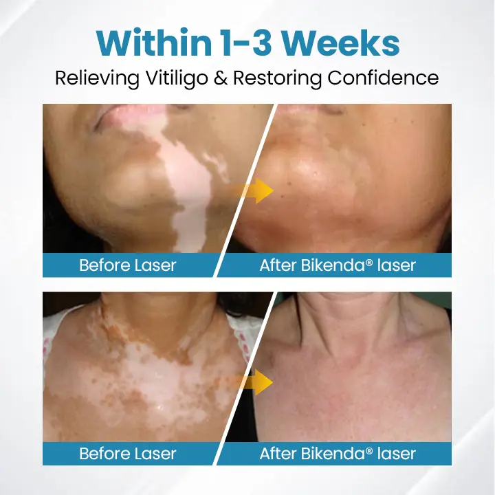 DermaBeam Vitiligo Therapy Device - Image 3