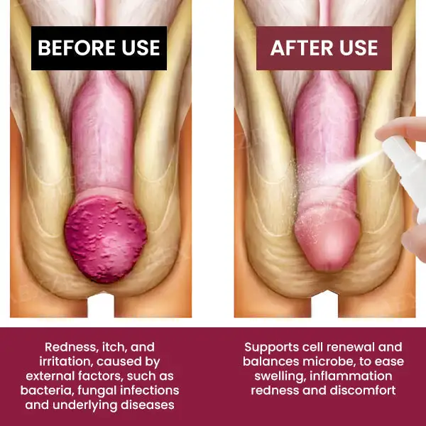 Balanitis Treatment Spray - Image 2