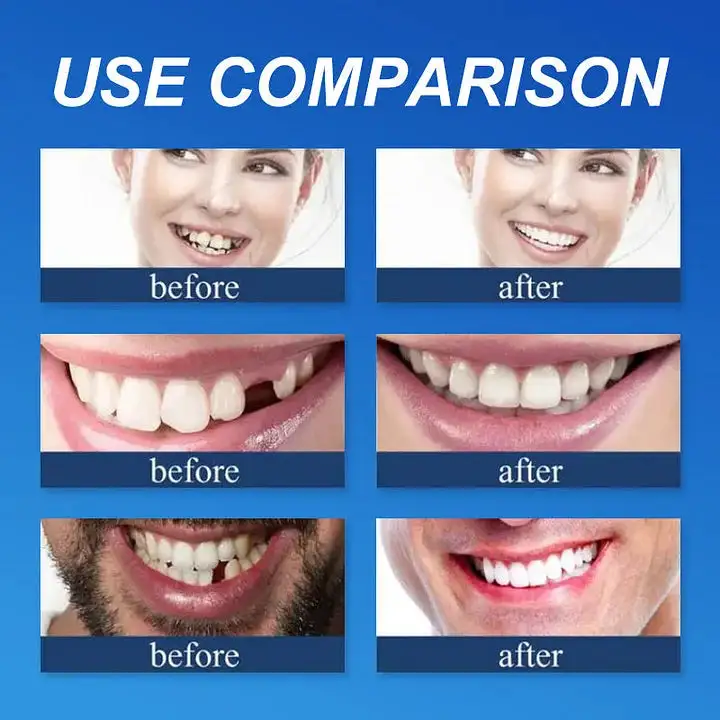Medical Full Denture with Strong Suctiond - Image 6