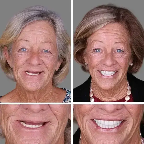 – Medical Full Denture with Strong Suctiond - Image 11