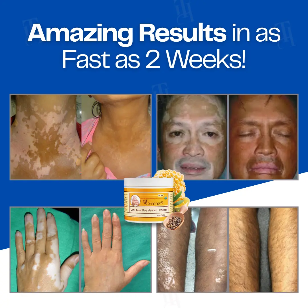 14 PCS Left - VitiClear Bee Venom Cream | No More Hiding that Skin!💕 - Image 2