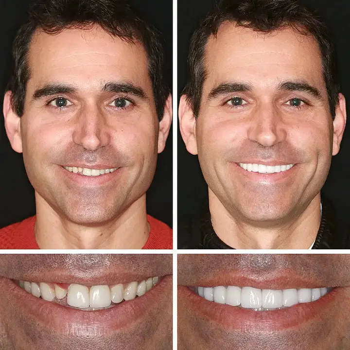 Medical Full Denture with Strong Suctiond - Image 11