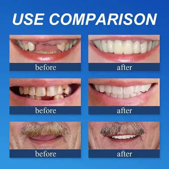 Medical Full Denture with Strong Suctiond - Image 21