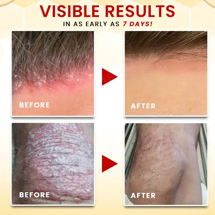 Bee Venom Psoriasis Treatment Cream - Image 2