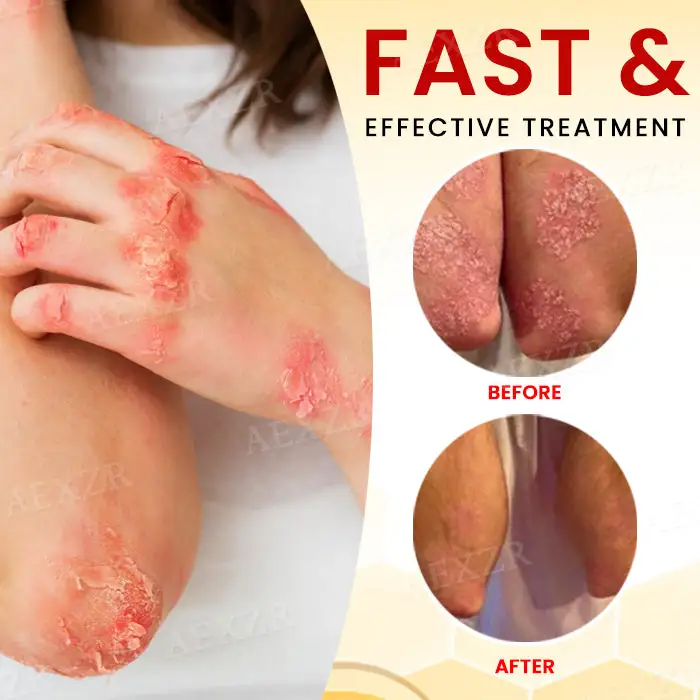 Bee Venom Psoriasis Treatment Cream - Image 3