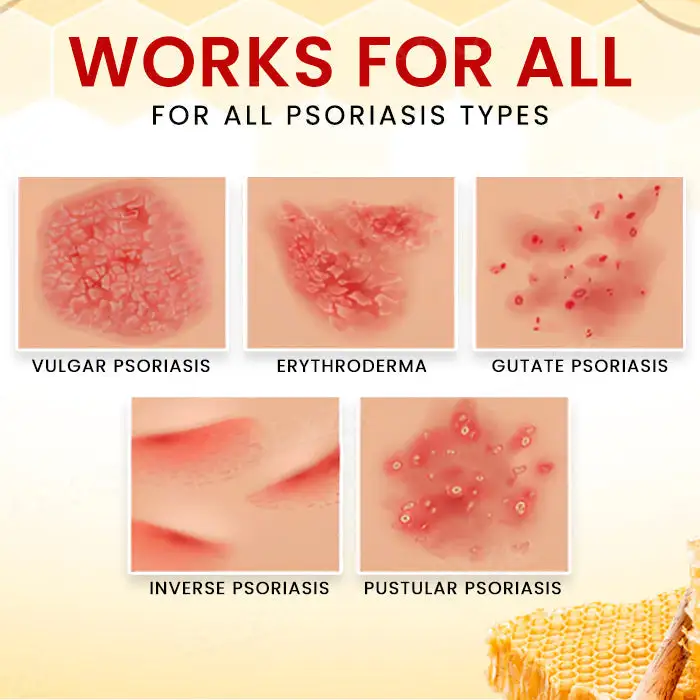 Bee Venom Psoriasis Treatment Cream - Image 4