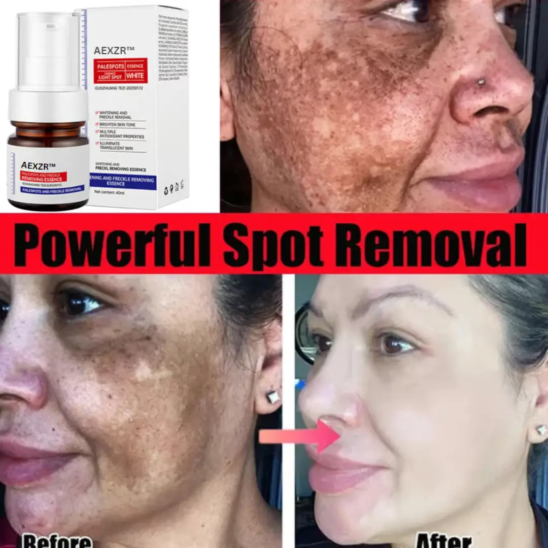 Vitamin C Whitening Freckles Face Cream Remove Melasma Dark Spots Lighten Melanin - Image 10