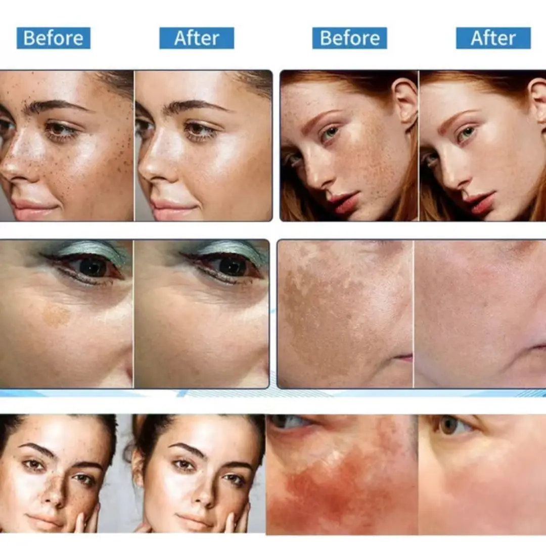 Vitamin C Whitening Freckles Face Cream Remove Melasma Dark Spots Lighten Melanin - Image 7