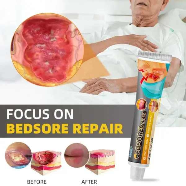 Bedsore Treatment Cream - Image 3