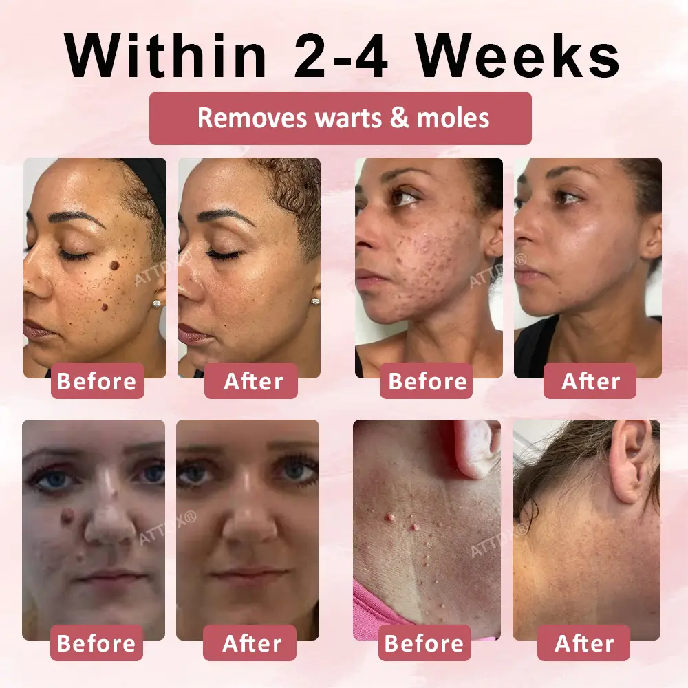 Tag & Blemish Peel-Off Gel Wrapping Mask - Image 3