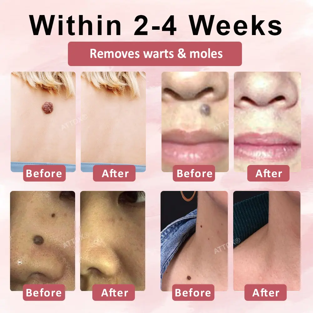 Tag & Blemish Peel-Off Gel Wrapping Mask - Image 4