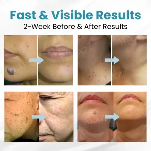 Professional Non-Invasive Mole and Wart Removal Laser Pen - Image 2