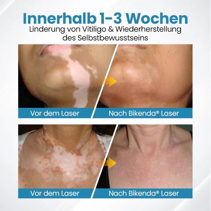 DermaBeam Vitiligo-Therapiegerät - Image 5