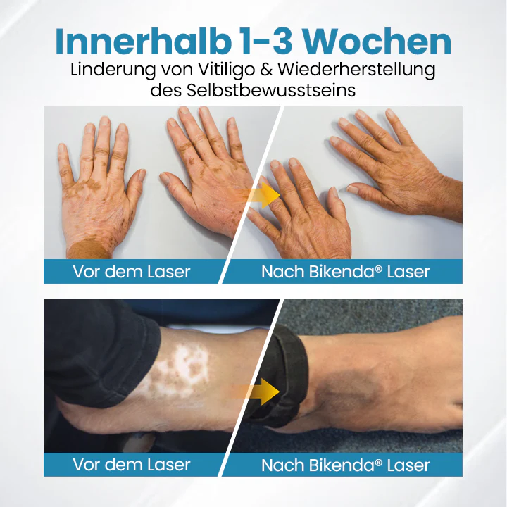 DermaBeam Vitiligo-Therapiegerät - Image 4