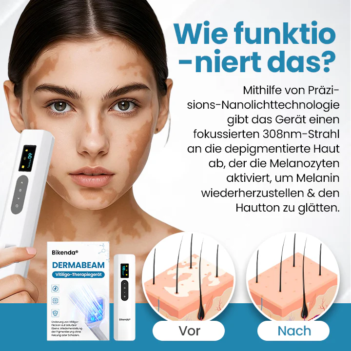 DermaBeam Vitiligo-Therapiegerät - Image 2