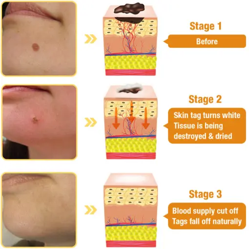 Bee Venom Mole and Wart Treatment Cream - Image 10