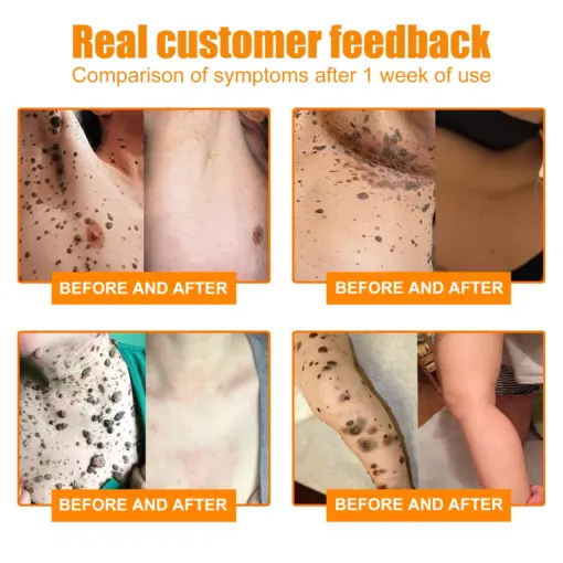 Bee Venom Mole and Wart Treatment Cream - Image 3