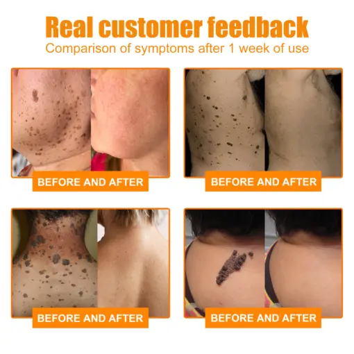 Bee Venom Mole and Wart Treatment Cream - Image 4