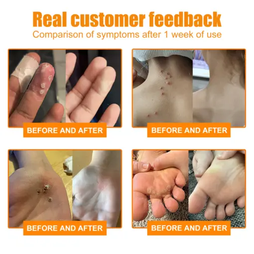 Bee Venom Mole and Wart Treatment Cream - Image 5