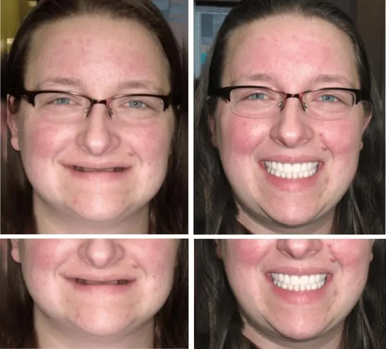 Custom-Fit Functional Dentures - Image 4