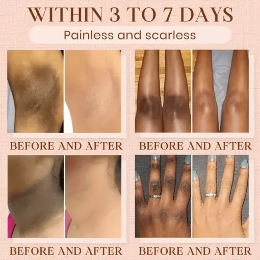 Purifying Exfoliating Gel for Acanthosis Nigricans, Exfoliation, Dark Spots, Skin Tags, and Eczema - Image 3