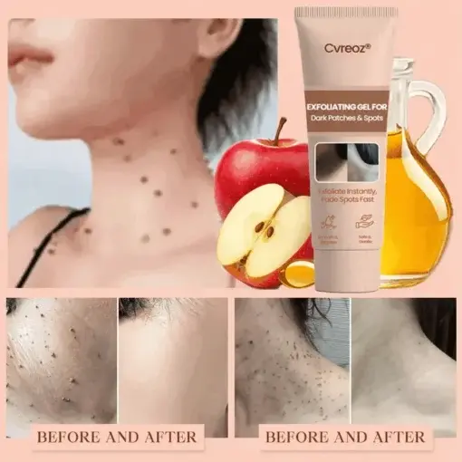 Purifying Exfoliating Gel for Acanthosis Nigricans, Exfoliation, Dark Spots, Skin Tags, and Eczema - Image 4