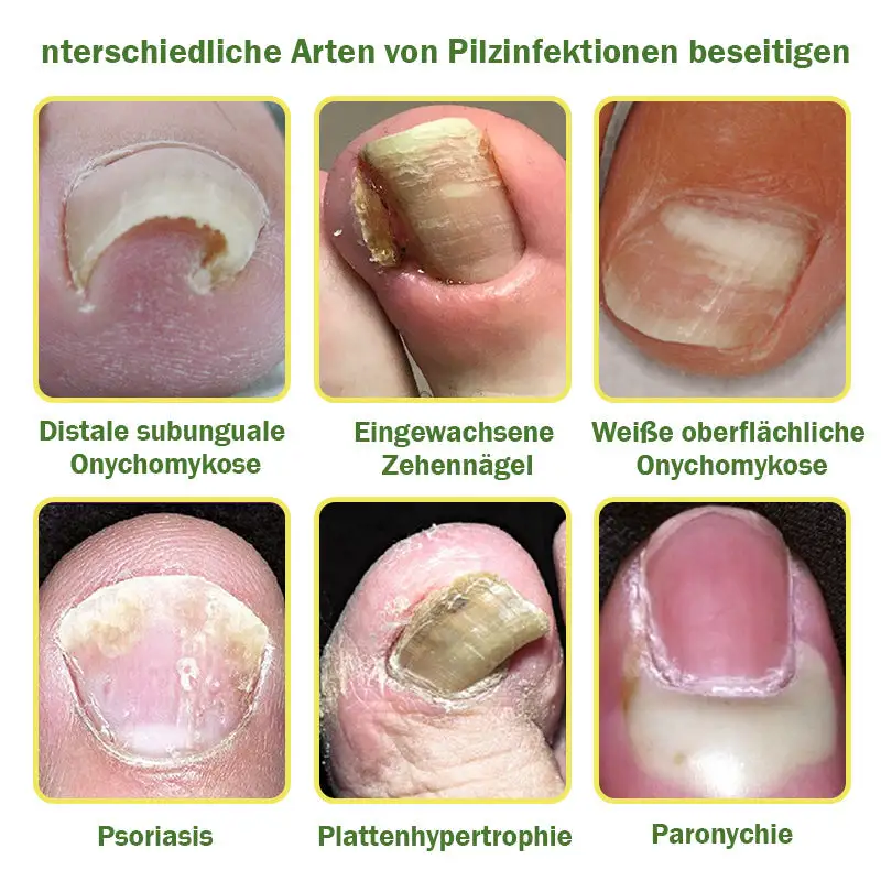 Nail Fungus Treatment Serum - Image 8