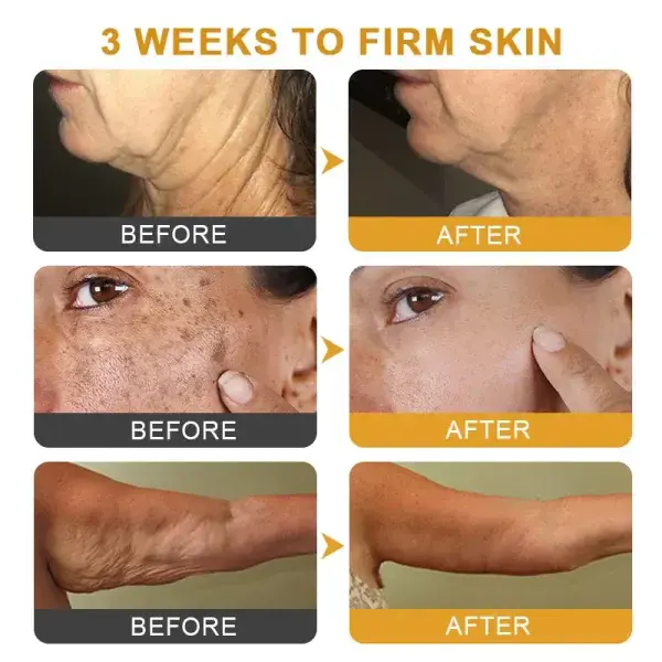 Botox Bee Venom Wrinkle - Image 9