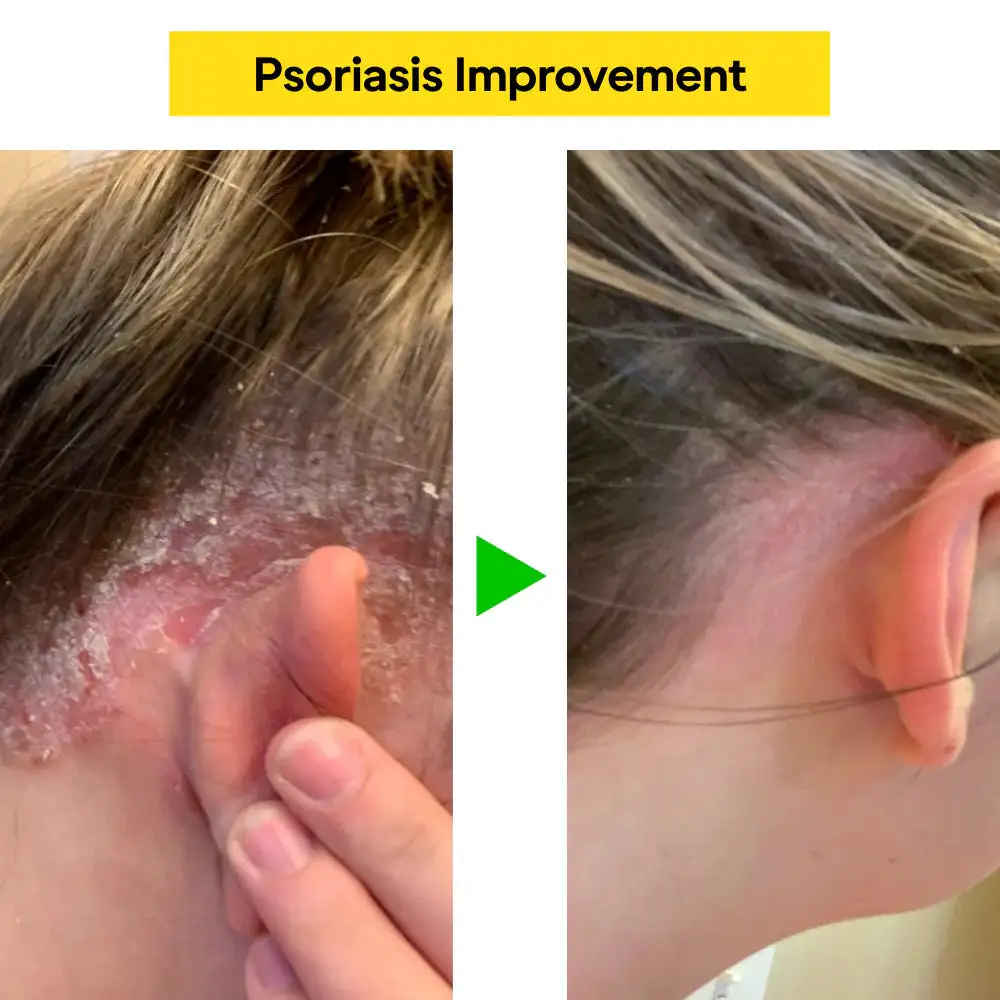 Eczema & Psoriasis Natural Herbal Cream - Image 3