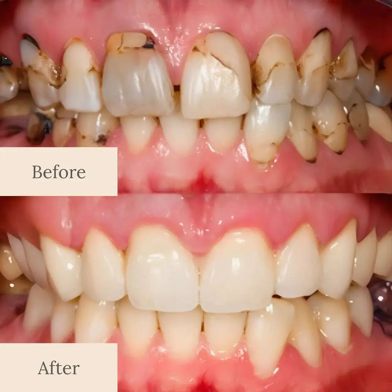 Nano-Hydroxyapatite Deep-Fusion Drops Advanced Enamel - Image 8