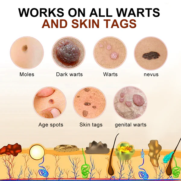 Bee Venom Mole and Wart Treatment Cream - Image 5