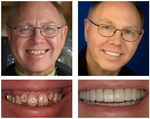 Custom-Fit Functional Dentures - Image 6
